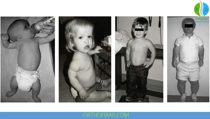 children with achondroplasia dwarfism
