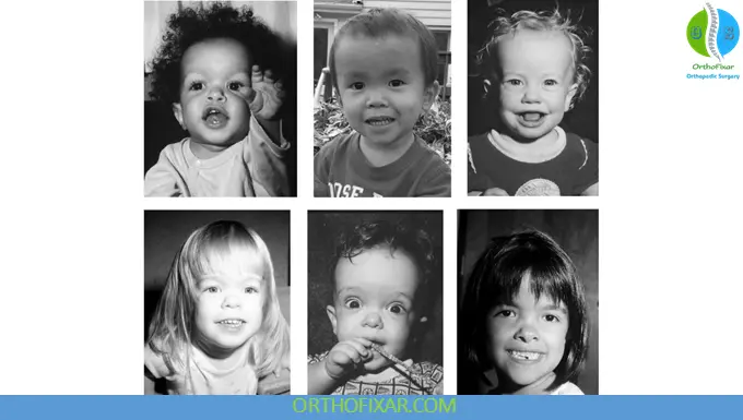 children with achondroplasia