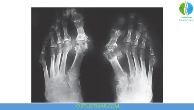 chronic Gout