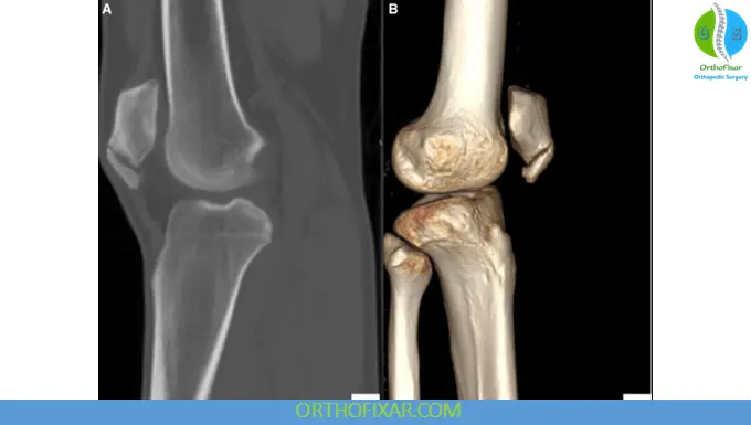 chronic Sinding-Larsen-Johansson Syndrome