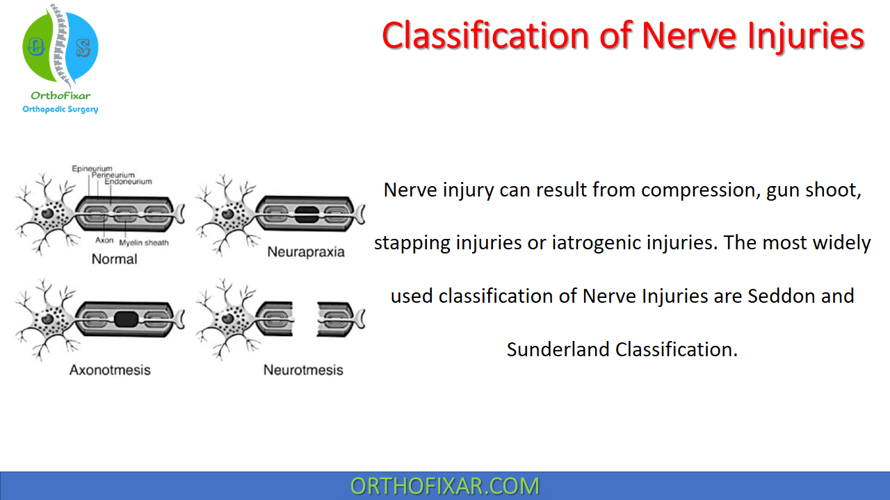 Classification of Nerve Injuries