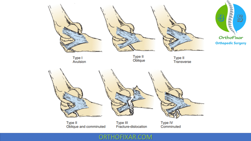 classification of olecranon fractures