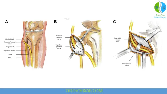 common Peroneal Nerve courses