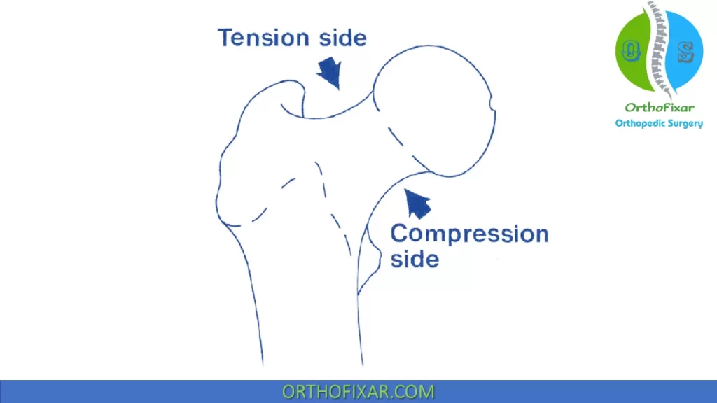 compression and tension side of the femoral neck