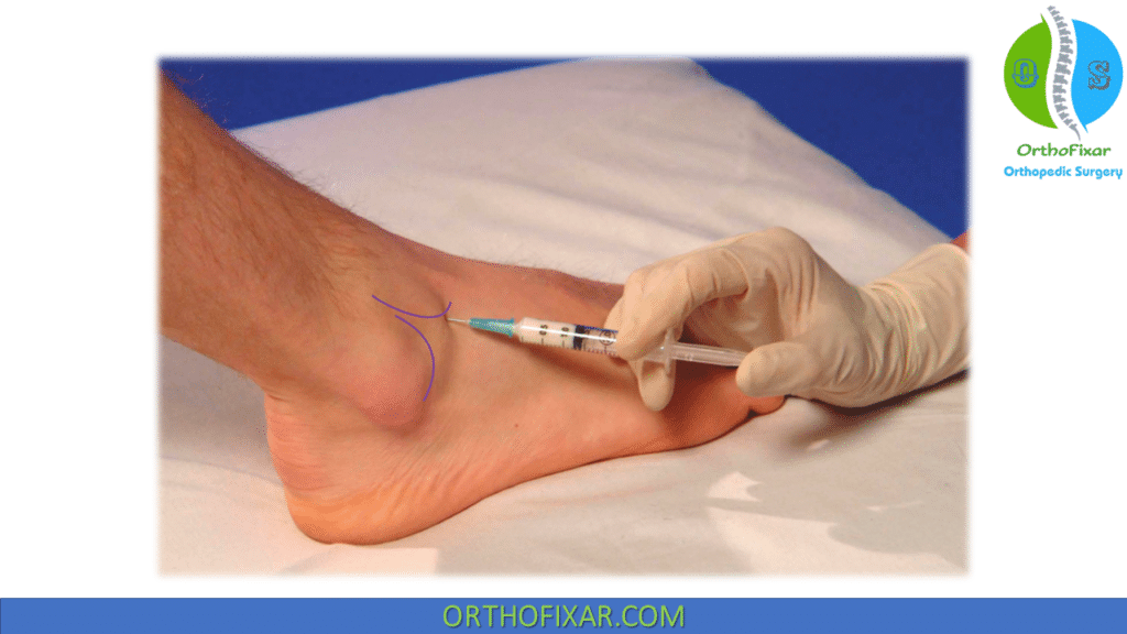 cortisone injection in ankle