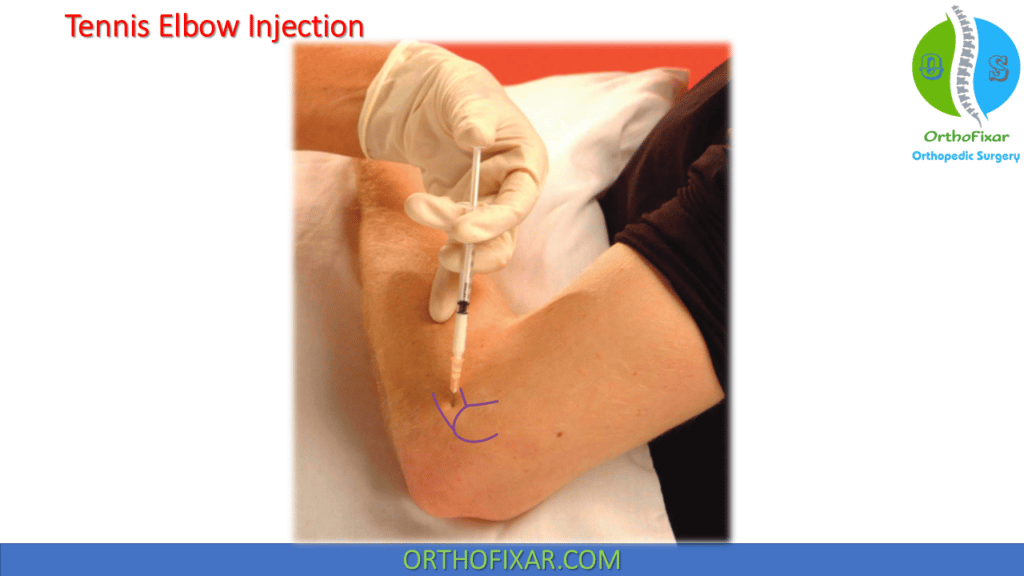 tennis elbow injection