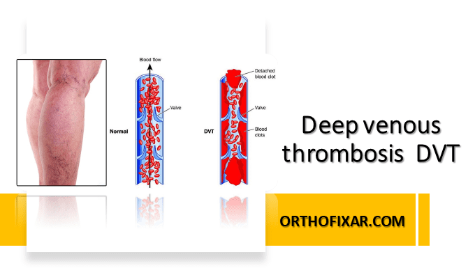 Deep Venous Thrombosis (DVT) | OrthoFixar 2024