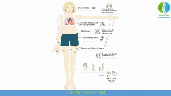 definition of marfan syndrome