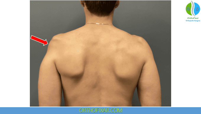 Axillary Nerve Injury 4 deltoid atrophy