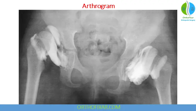 Arthrography: Indications, Technique, Uses & Interpretation 5 direct Arthrography