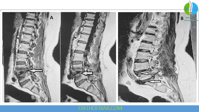 Discitis: Spinal Infection Symptoms, Diagnosis & Treatment 5 discitis mri