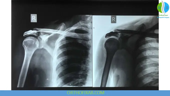 Acromial Fractures: Diagnosis, Classification & Treatment 8 displaced Acromial Fracture