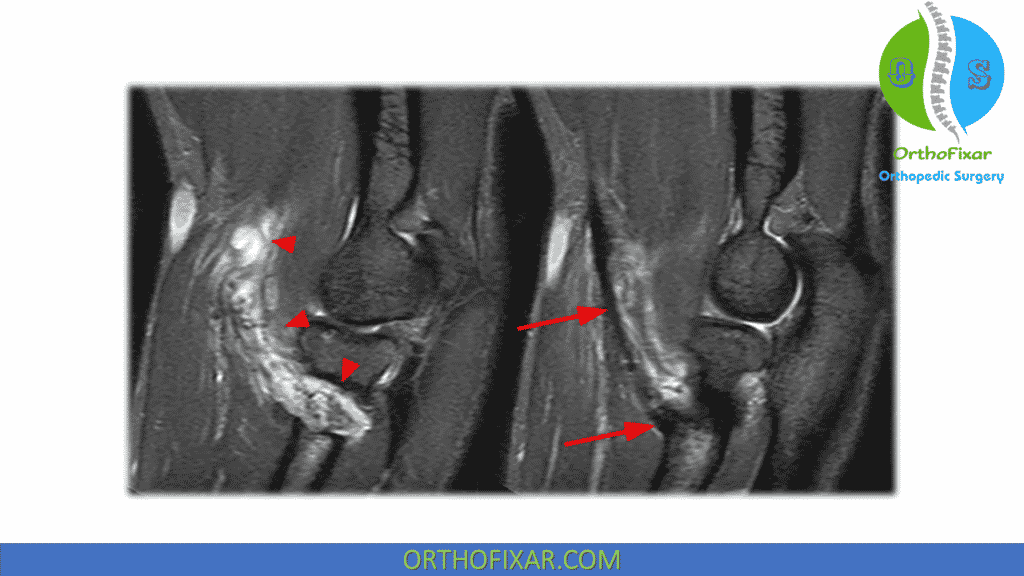 distal bicep tendon tear on MRI