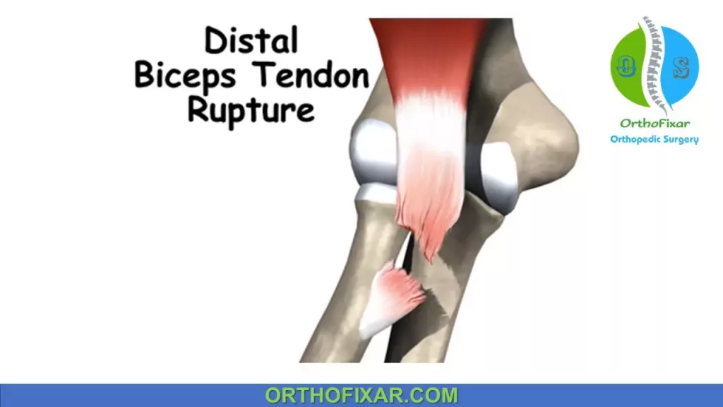 distal biceps tendon avulsion