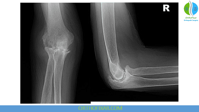 Elbow Arthritis: Symptoms, Diagnosis & Treatment Options 3 elbow arthritis