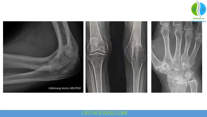Ankylosis: Definition, Causes, Symptoms, Diagnosis, and Treatment 3 elbow, knee, wrist Ankylosis