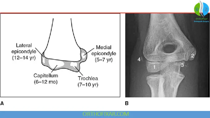 Lateral Humeral Epicondyle Fractures 4 elbow ossification centers