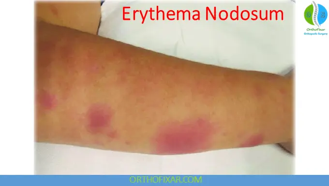 Erythema Nodosum: Causes, Clinical Features & Management 7 erythema nodosum pictures