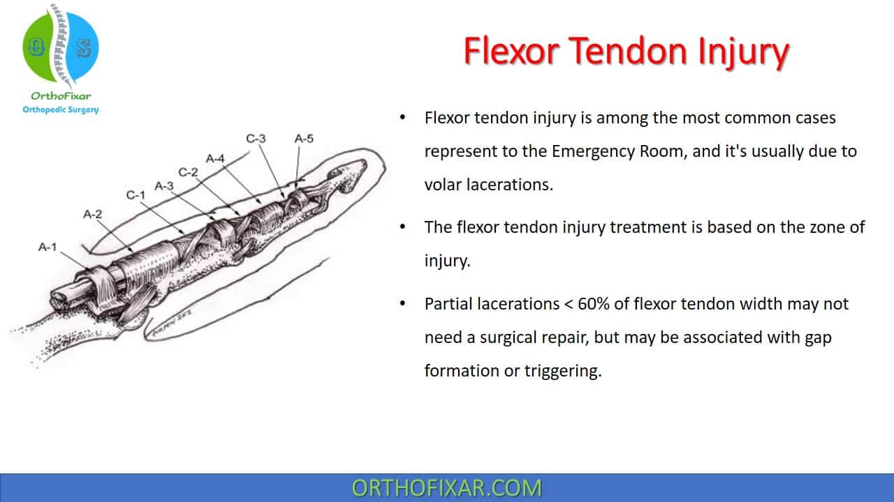  Hand Flexor Tendon Injury 