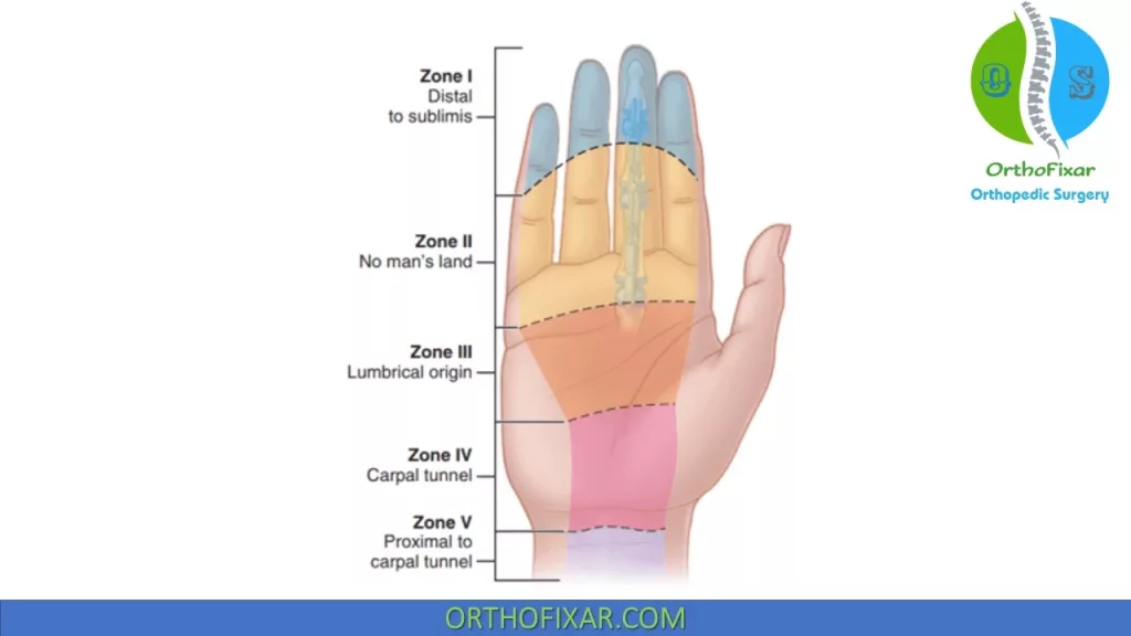 thumb flexor tendon zones 
