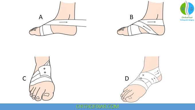 Antipronation Taping for Foot Hyperpronation Injury 1 foot Antipronation Taping