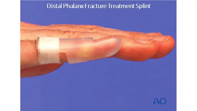 fractured distal phalanx treatment - splint