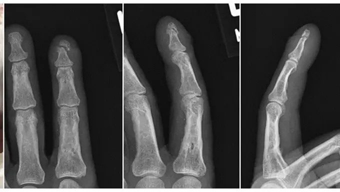 fractured distal phalanx