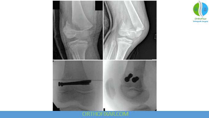 fractured growth plate in knee