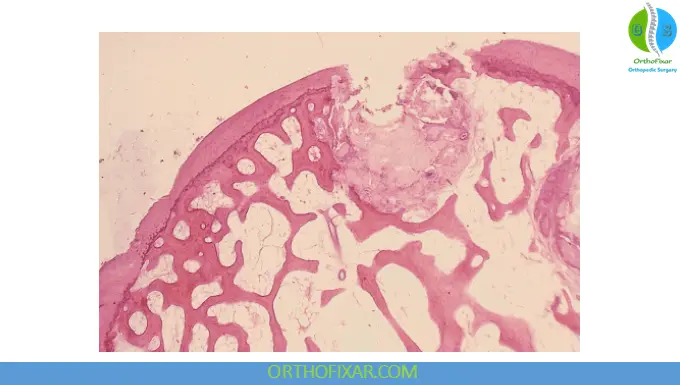 gout histology