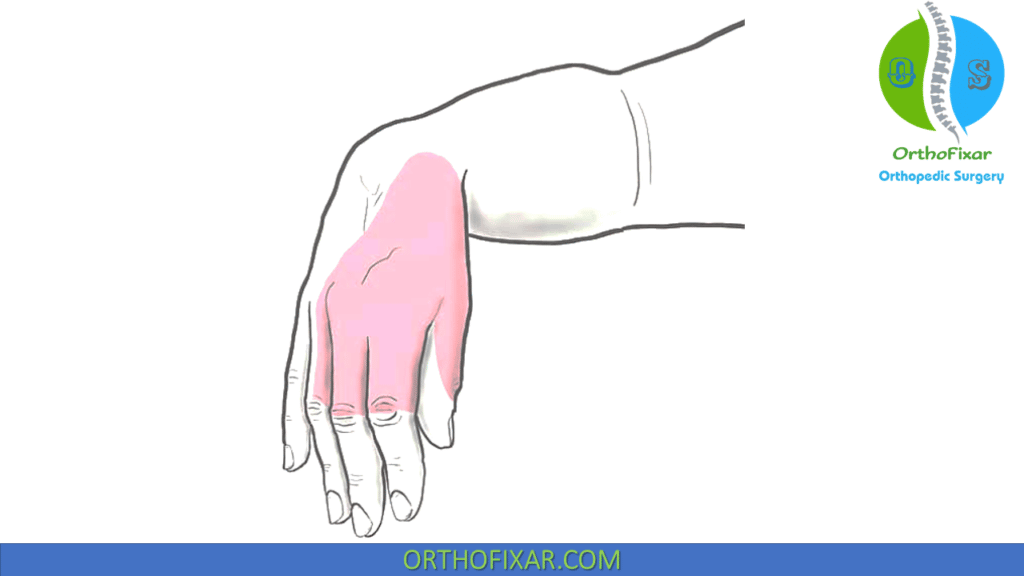 hand drop after midshaft humerus fracture