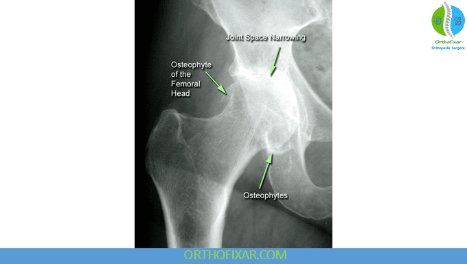 hip osteoarthritis