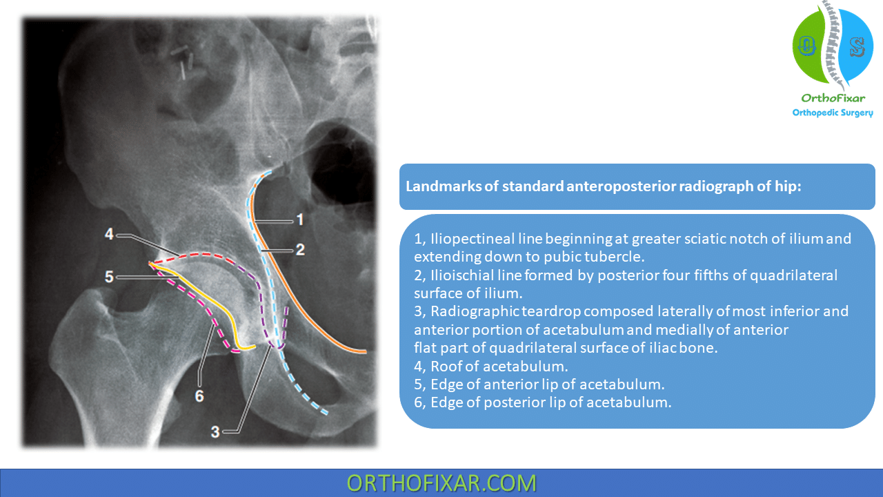 Acetabulum Fracture Full Explained | OrthoFixar 2025