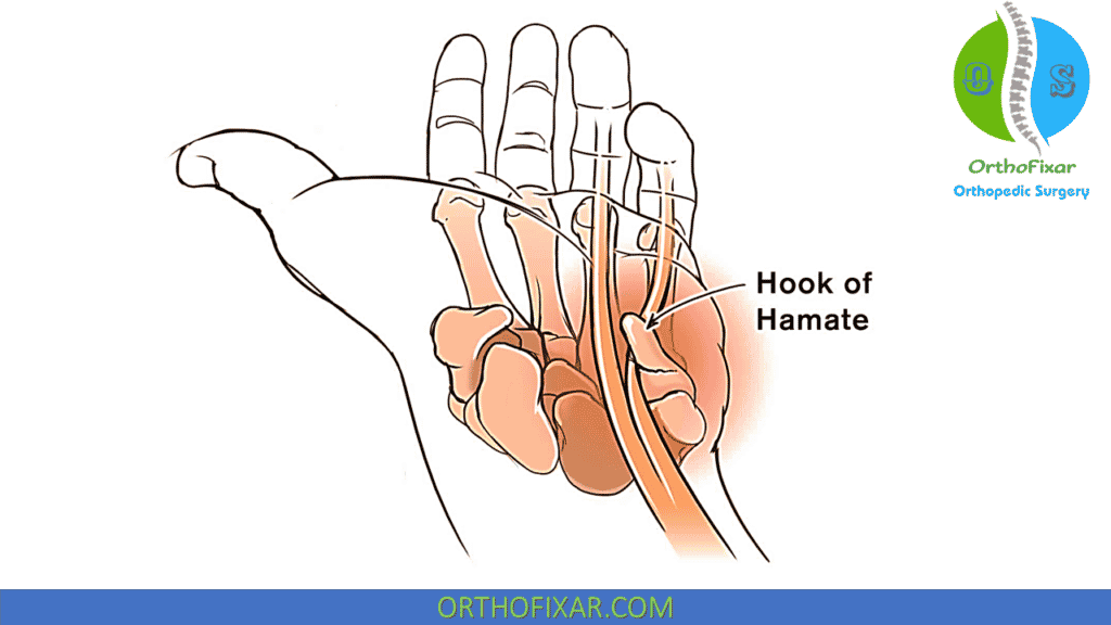 hook of hamate and ulnar nerve