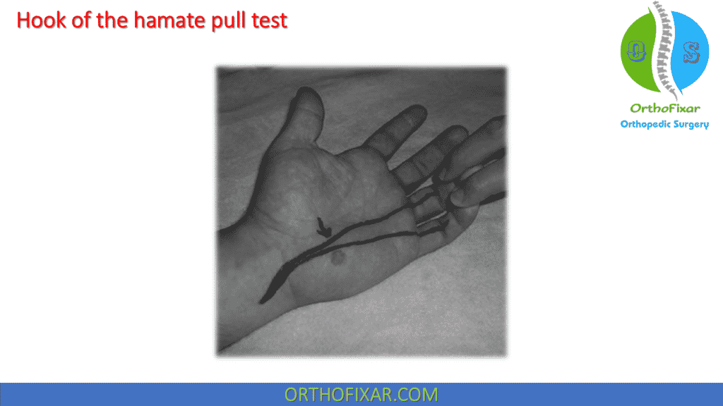 hook of the hamate pull test