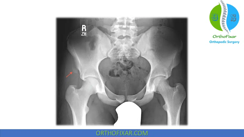 Hip Pointer Injury Causes, Symptoms & Treatment 3 iliac crest fracture