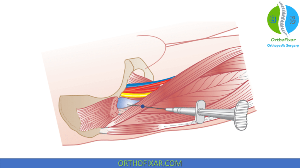 iliopsoas bursa injection technique