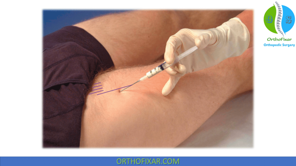 iliopsoas bursa injection technique