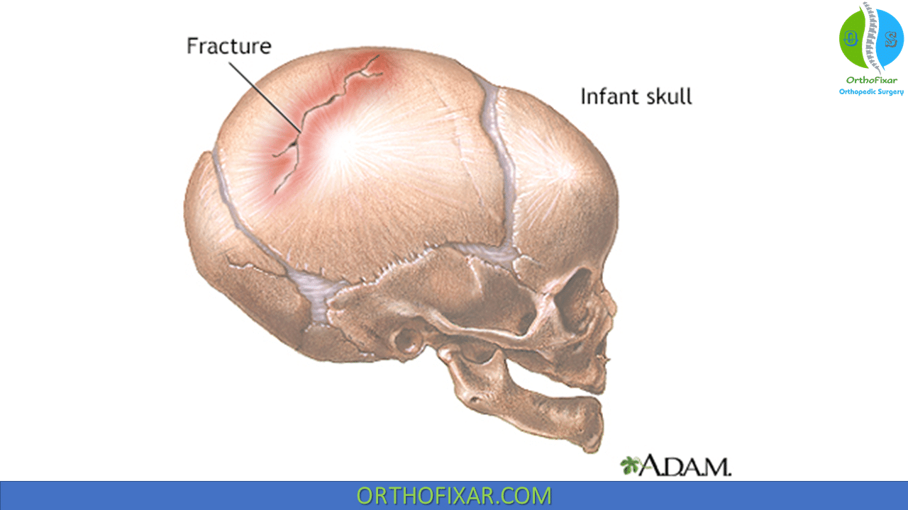 Skull Fracture Overview & Treatment | OrthoFixar 2024