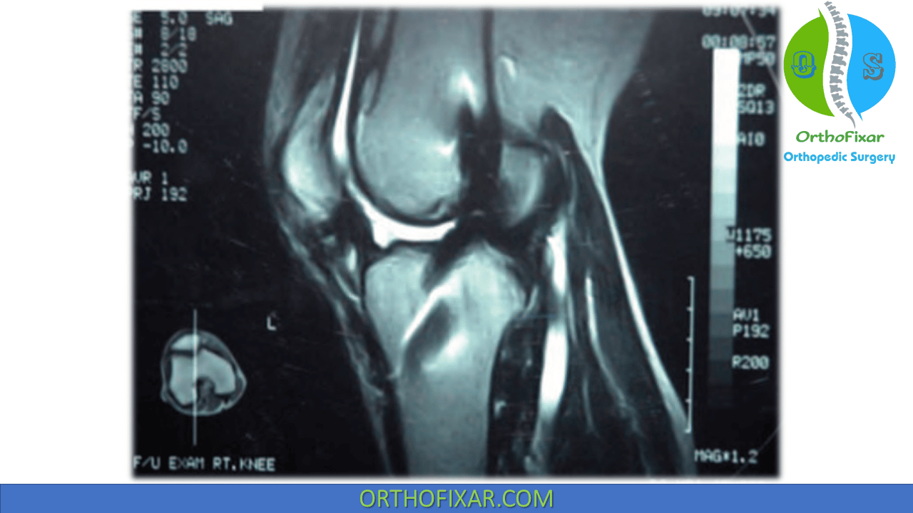 Knee Arthrofibrosis | OrthoFixar 2024