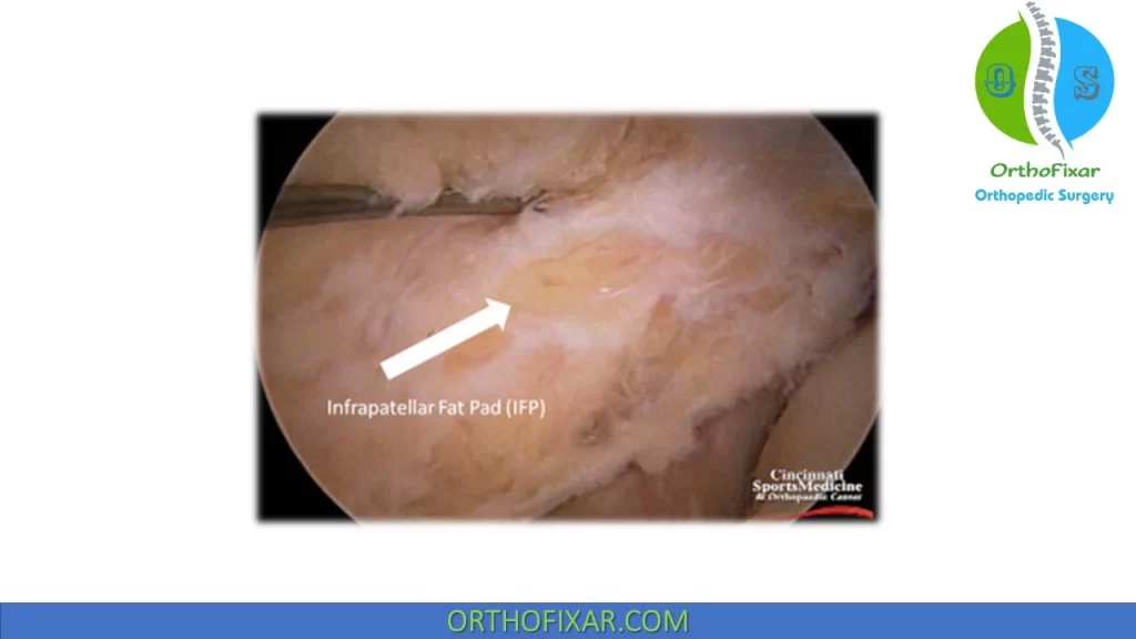 infrapatellar fat pad Arthroscopy