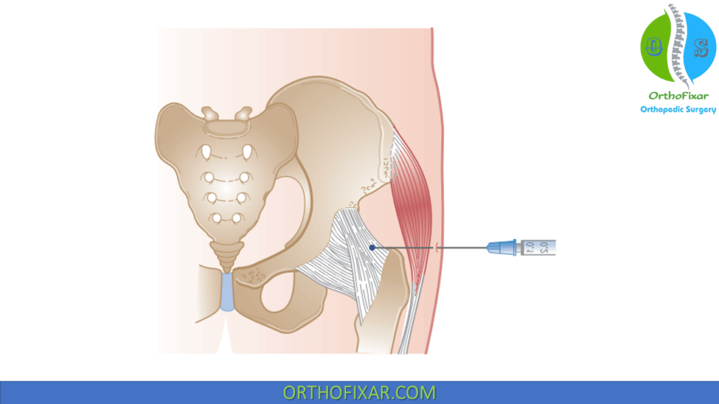 injections for hip pain