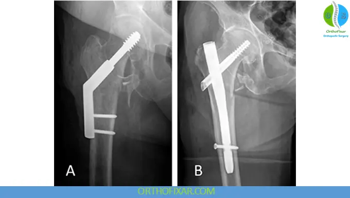 intertrochanteric fracture surgery