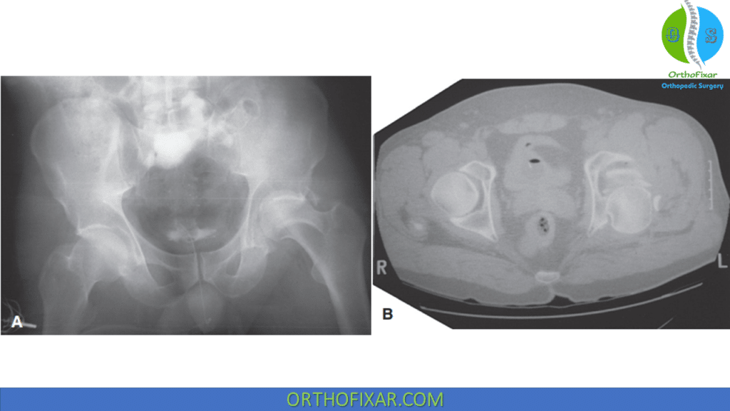 irreducible hip dislocation with posterior wall acetabular fracture