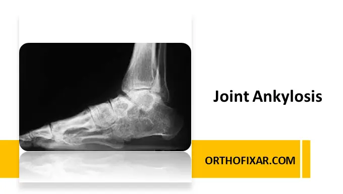 joint Ankylosis