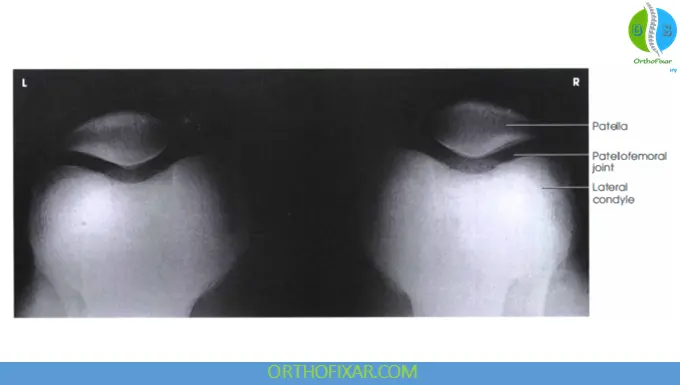 knee Axial (SkylineSunrise) View