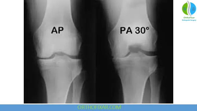 knee Fixed Flexion Posteroanterior View