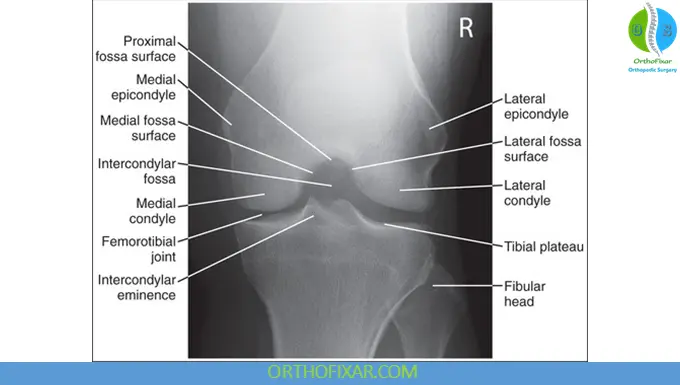 knee Intercondylar Notch (Tunnel) View
