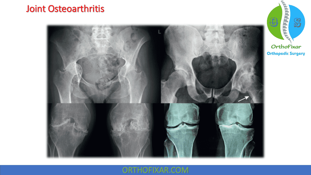 knee and hip osteoarthritis