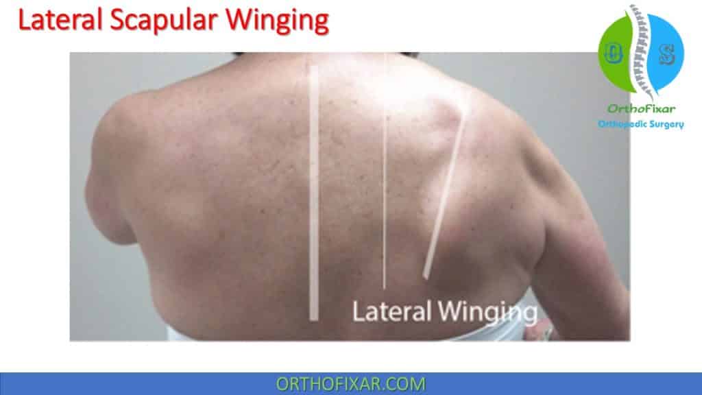 lateral Scapular Winging