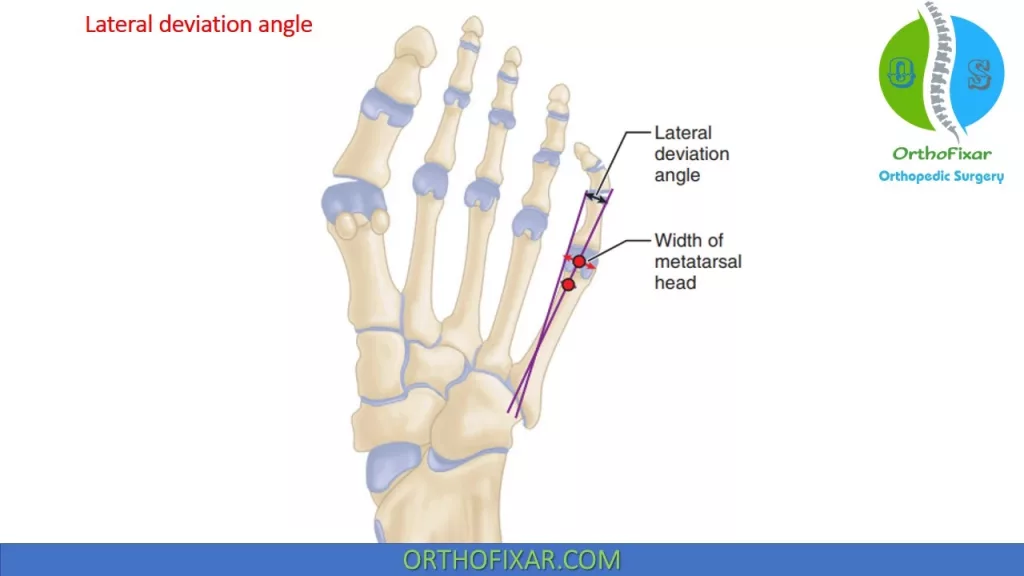 lateral deviation angle